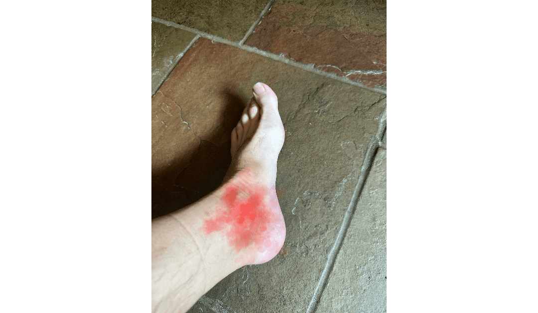 Gout